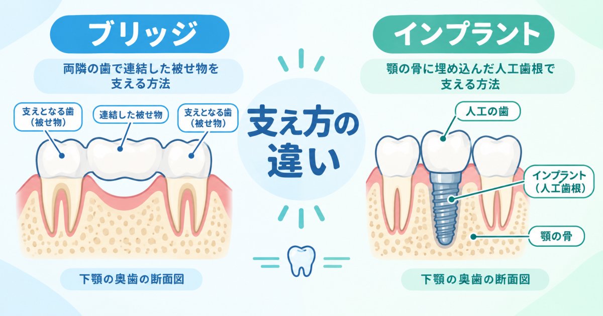 抜歯した奥歯の位置で、選べる治療法はどう変わる?