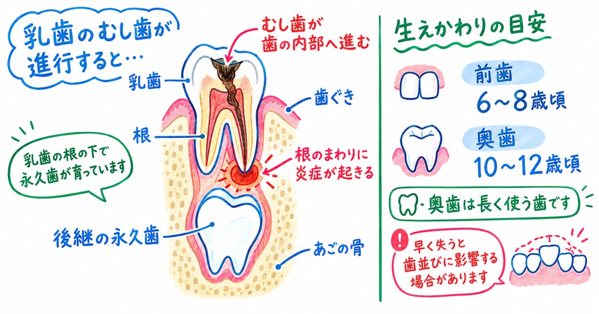 乳歯のむし歯が永久歯に与える影響と生え変わり時期に合わせた対処法