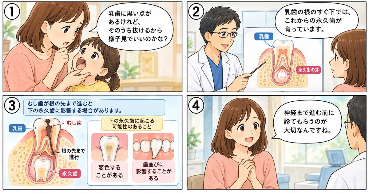 乳歯のむし歯が永久歯に影響する条件とは?深さ・炎症・歯の位置で変わる理由